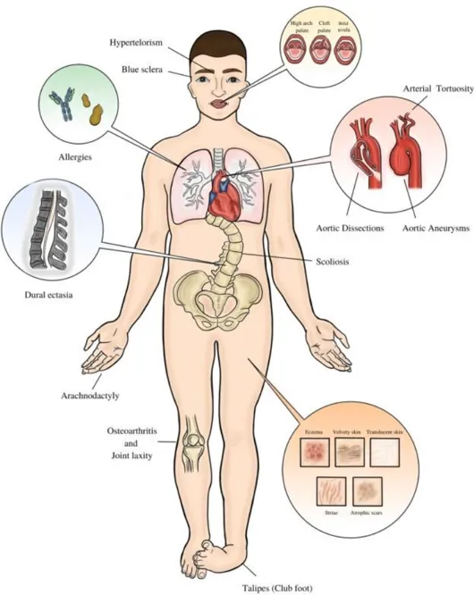 menneske med organer som kan være påvirket ved LDS