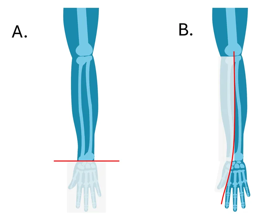 tversgående og langsgående underarmsdysmeli