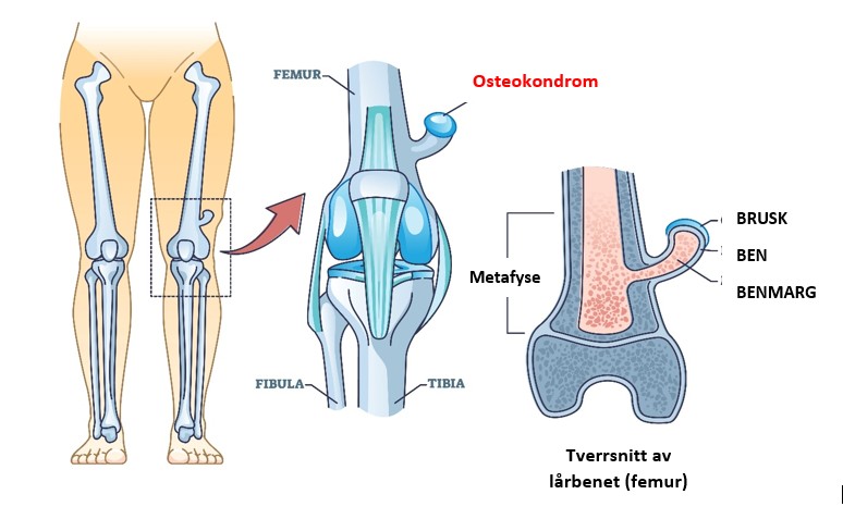 Illustrasjon som viser osteokondrom på lårbenet