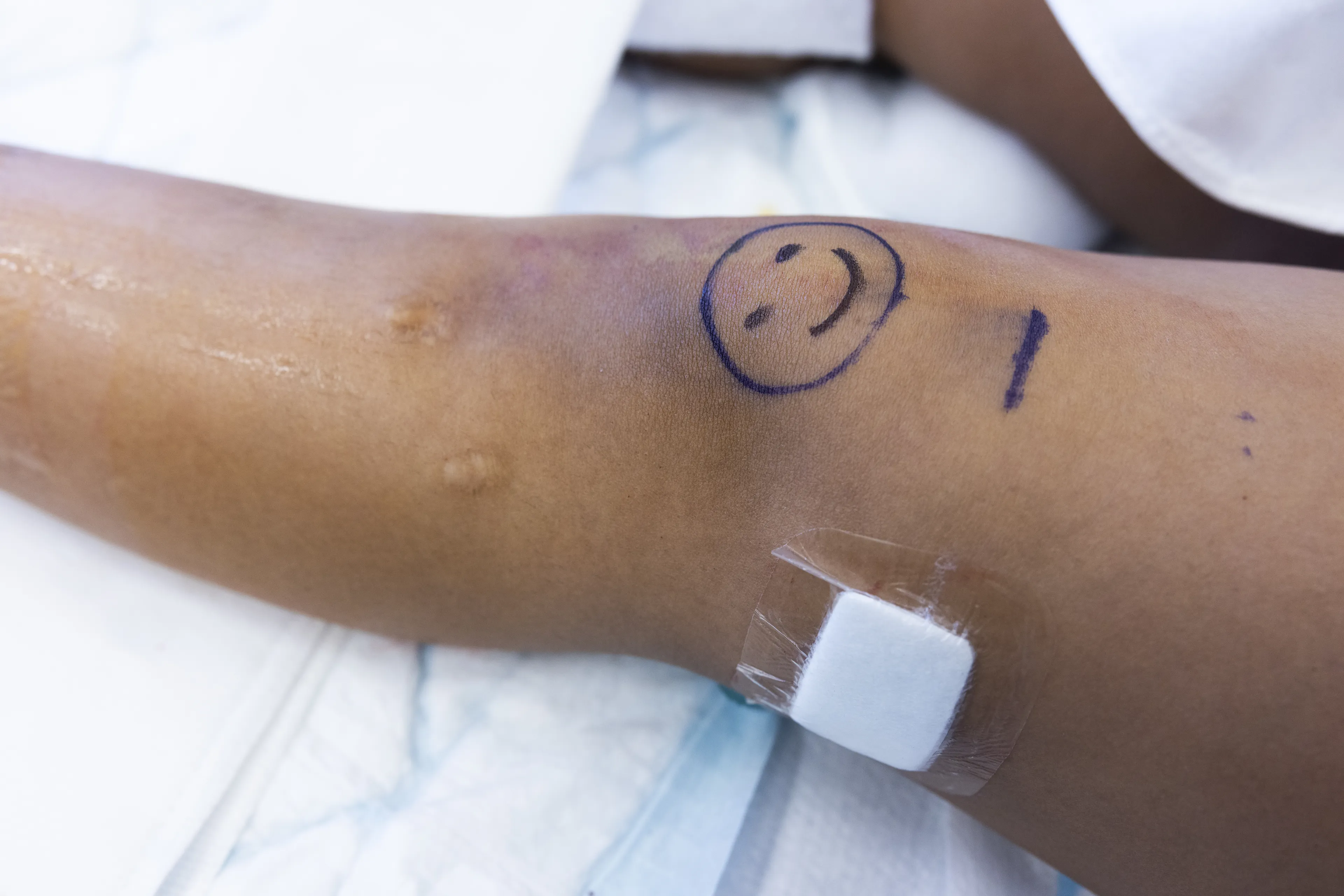 Bein med smilefjes tegnet på kneet