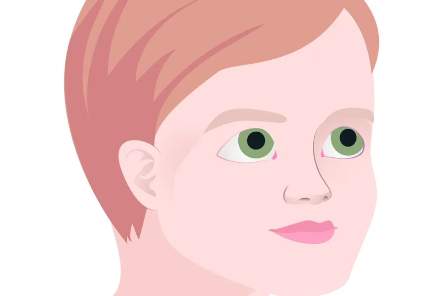 Illustrasjon av person med kjerubisme med oppadvendte øyne
