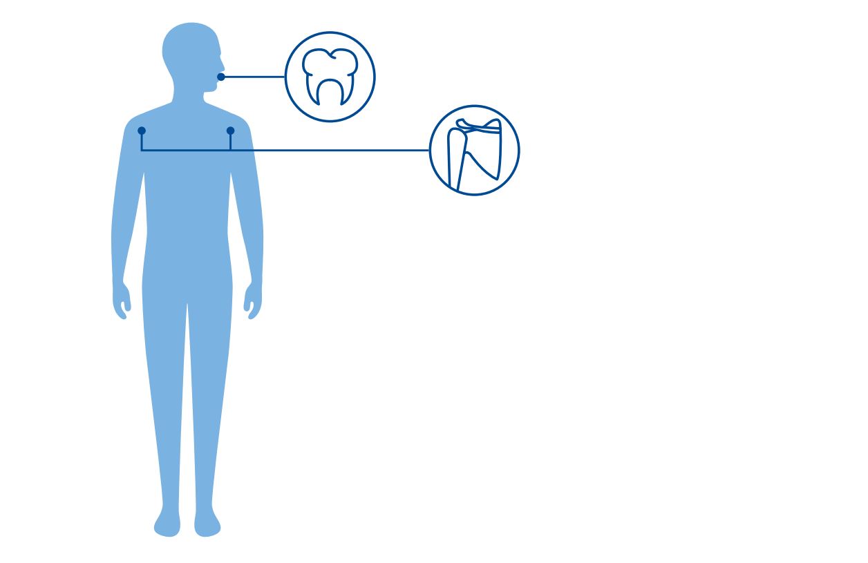 Illustrasjon av påvirkning av kragebein og hodeskalle ved Cleidocranial dysplasi