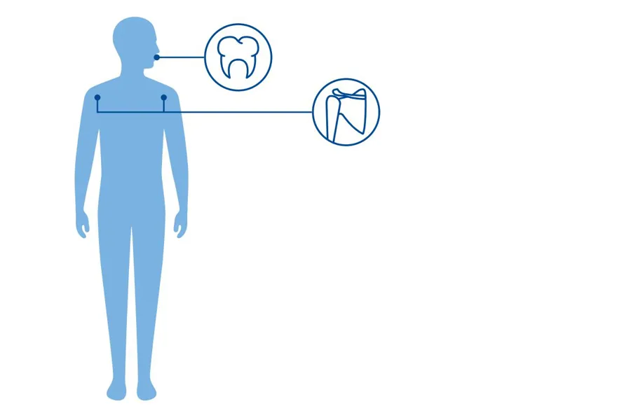 Illustrasjon av Cleidocranial dysplasi, med påvirkning av kraveben og tenner