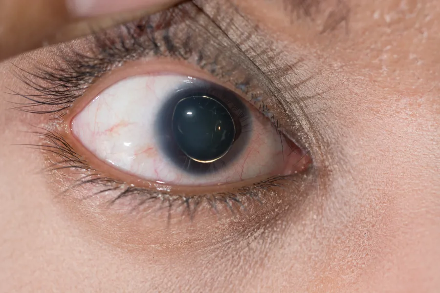 Bilde av løs linse i øyet ved Marfans syndrom