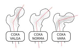 Bilde av hofteleddsfeilstillinger ved OI