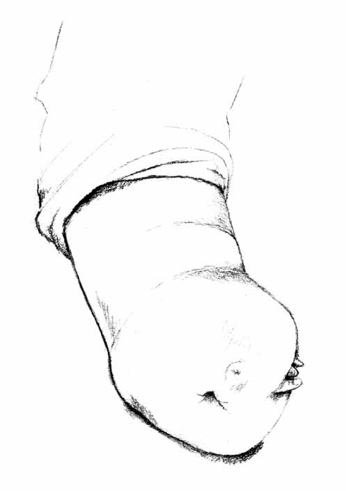 Bildet viser en arm med tversgående dysmeli