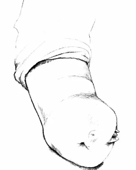 Bildet viser en arm med tversgående dysmeli