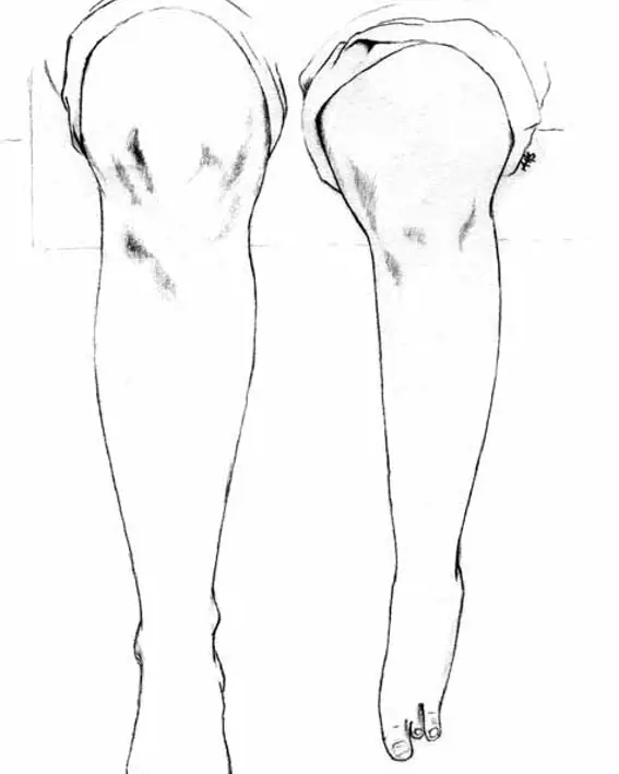 Bildet viser tenging av to ben, med ben dysmeli på det ene benet Mindre og kortere enn det andre) det ene 
