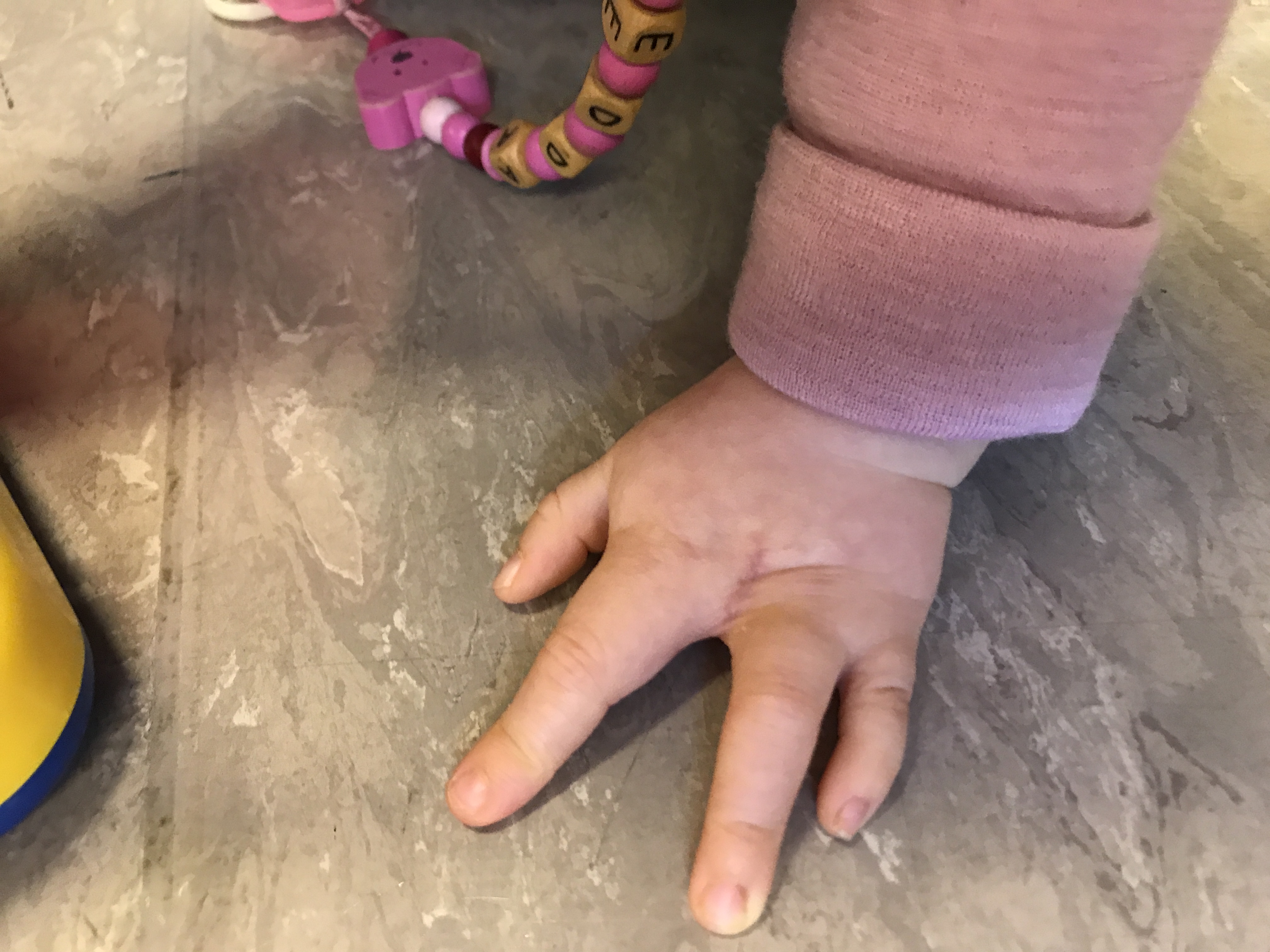 Barn med splittet hånddysmeli