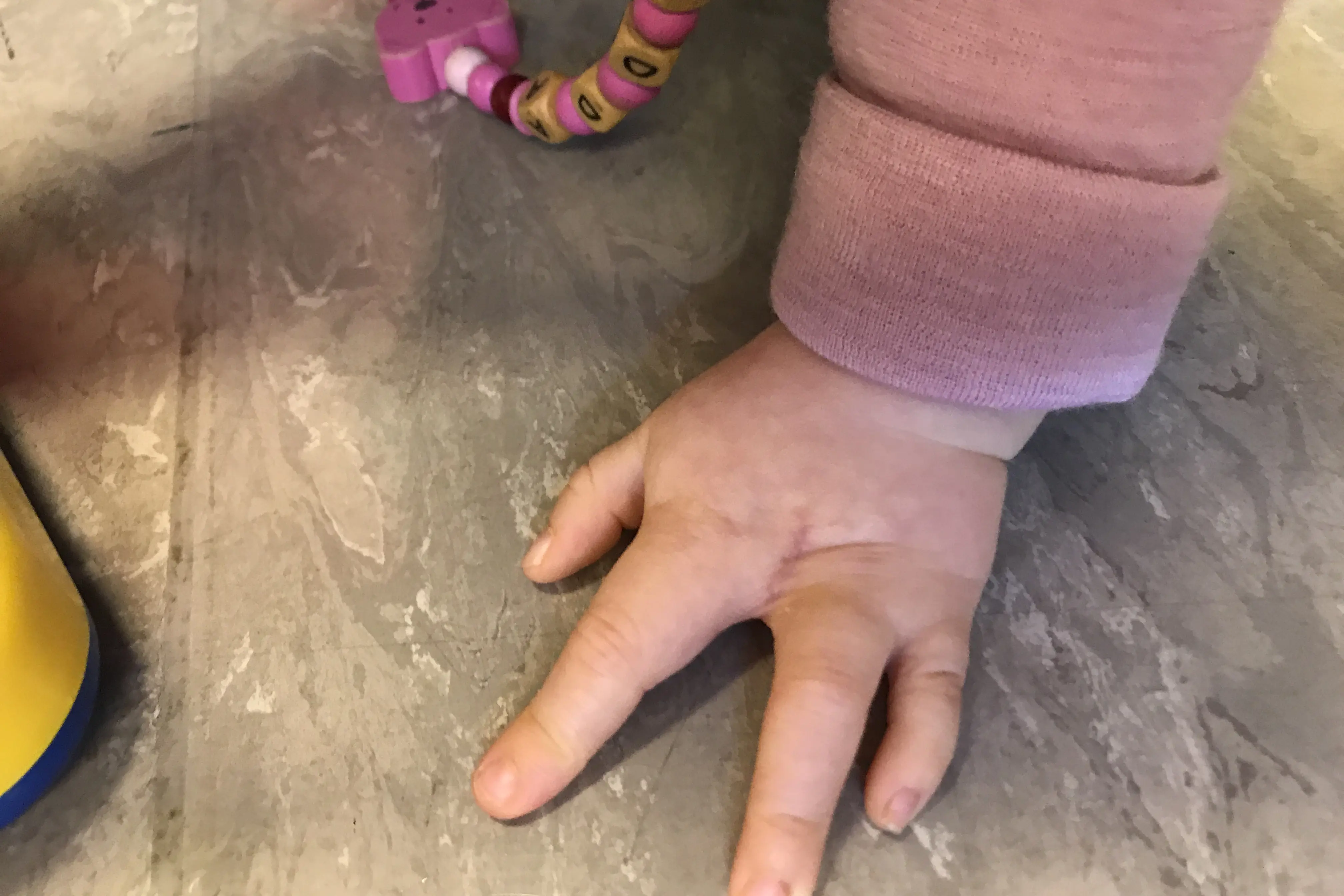 Barn med splittet hånddysmeli