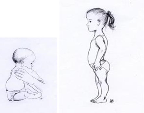 Tegning av spedbarn og litt eldre barn med akondroplasi