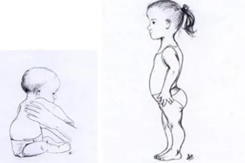 Tegning av spedbarn og litt eldre barn med akondroplasi