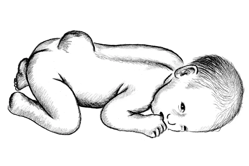 Spebarn med ryggmargsbrokk, illustrasjon
