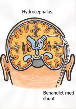 Hydrocephalus behandlet med shunt