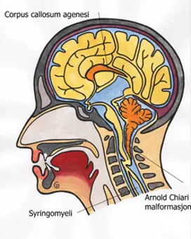 Illustrasjon viser hjerne med Arnold Chiari malformasjon