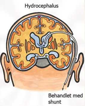 Illustrasjonen viser hjerne med hydrocephalus  og behandling med shunt