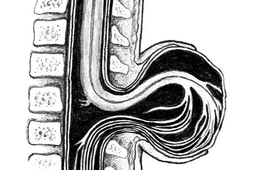 Tegning av ryggmargsbrokk