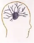 illustrasjon av hode med epileptisk anfall