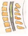 illustrasjon av ryggmarg med syringomyeli