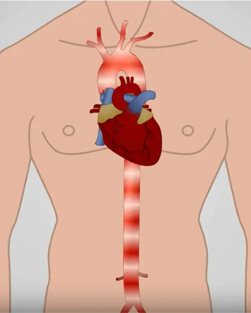 Illustrasjon av hjerte og hovedpulsåre
