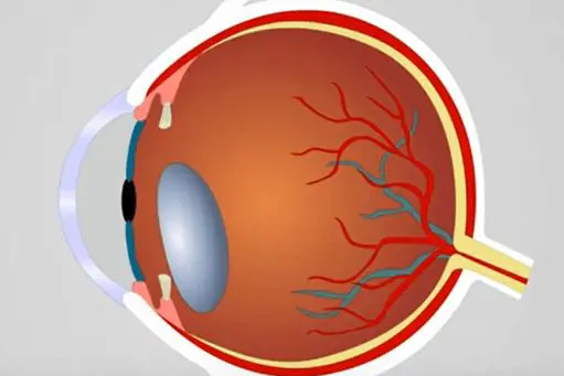 Illustrasjon av øyet og linseluksasjon