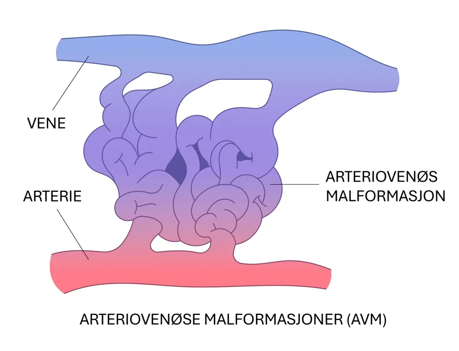 Illustrasjon av blodåre med arteriovenøs malformasjon