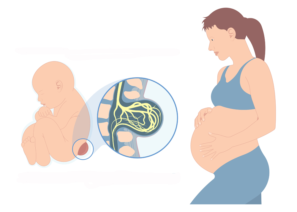 Foster med ryggmargsbrokk og gravid kvinne