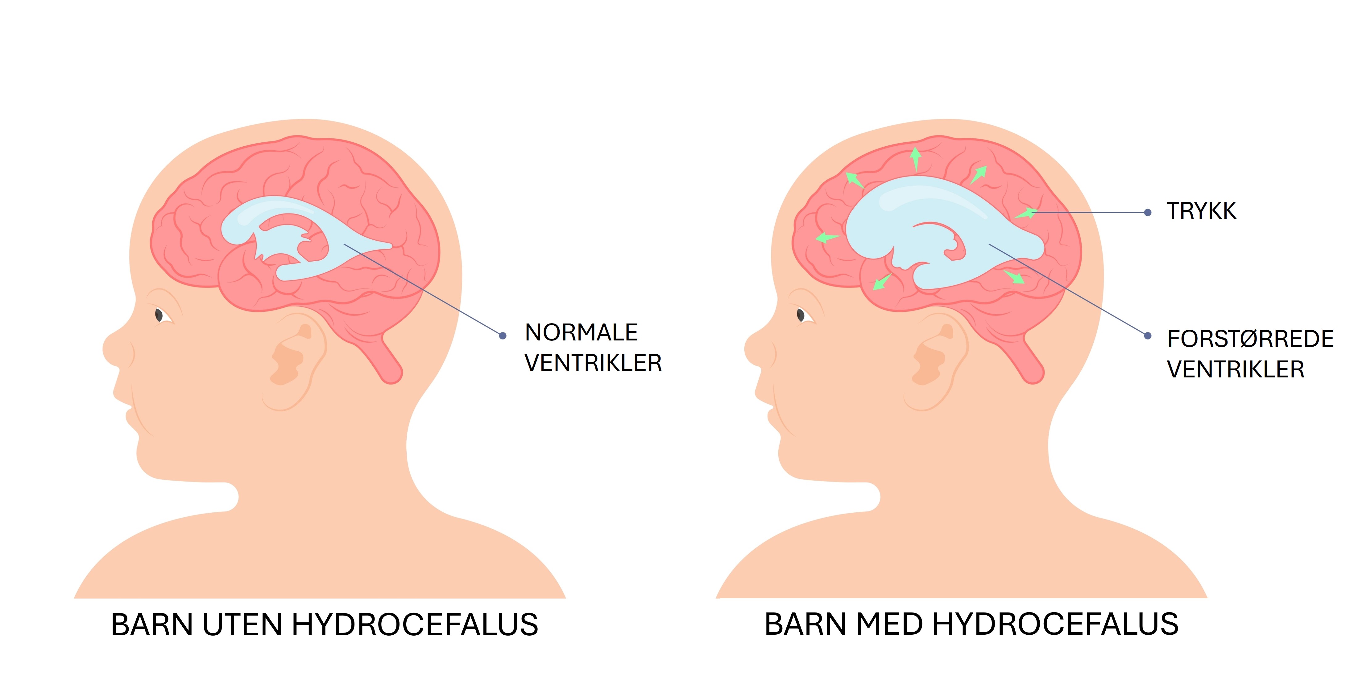 Barnehode med normale ventrikler, og et barnehode med et større blått felt i hjernen som viser forstørrede ventrikler ved hydrocefalus