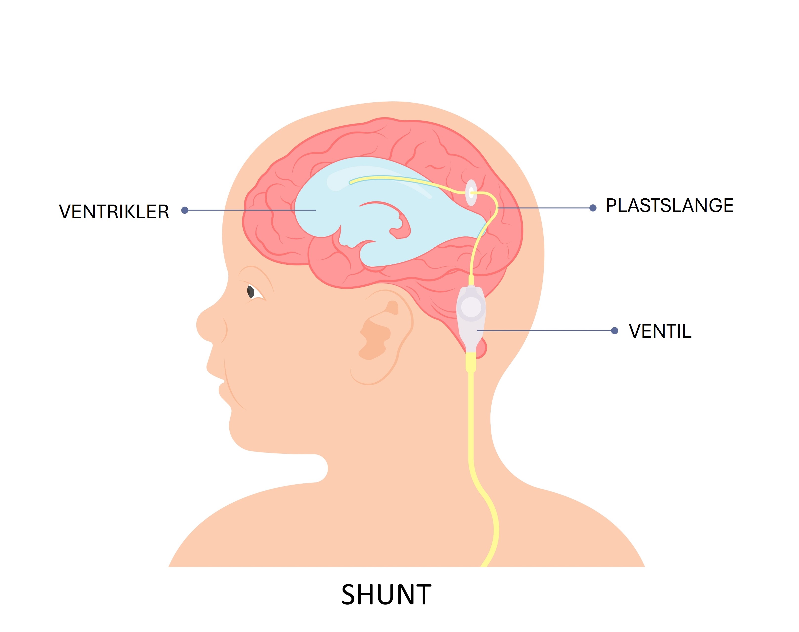 Barnehode med væskefylt ventrikkel. Slange går via ventil i retning buken